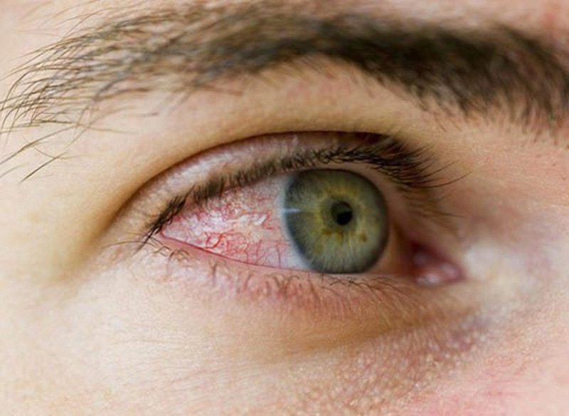 Cân nhắc sử dụng nhỏ mắt kháng sinh khi mắt bị nhiễm trùng