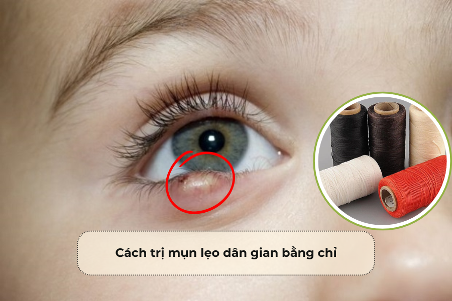 Cách trị mụn lẹo dân gian bằng chỉ