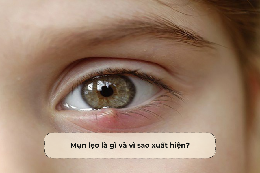Mụn lẹo là gì và vì sao xuất hiện