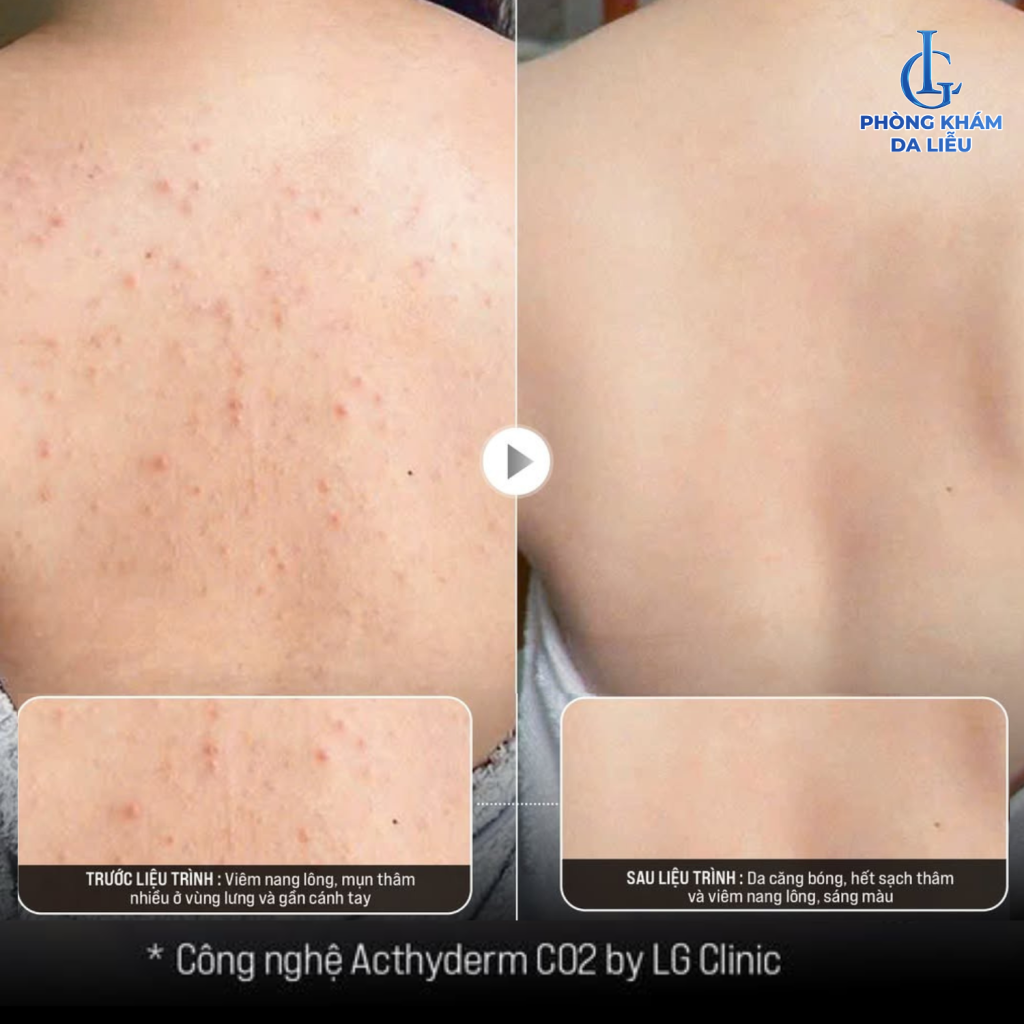 Khách hàng chia sẻ hiệu quả sau khi điều trị tại Phòng khám Da liễu LG