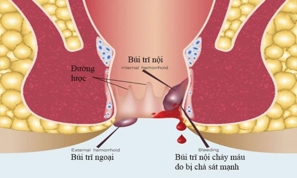 trĩ chỉ xảy ra ở vùng tĩnh mạch quanh hậu môn và trực tràng, không liên quan trực tiếp đến sự phát triển của thai nhi.