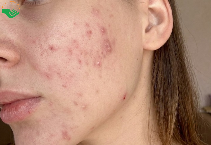 Dị ứng với thành phần của sản phẩm