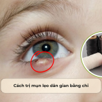 Cách trị mụn lẹo dân gian bằng chỉ: Hiệu quả hay mê tín?