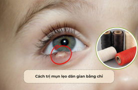 Cách trị mụn lẹo dân gian bằng chỉ