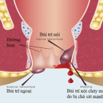 Bệnh trĩ khi mang thai có ảnh hưởng đến thai nhi không?